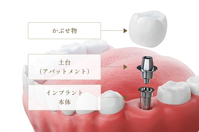 インプラントの基本構造の図解